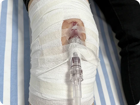 Aplicaci&oacute;n de yeso para aliviar el trauma