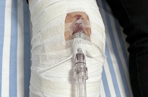 Aplicaci&oacute;n de yeso para aliviar el trauma